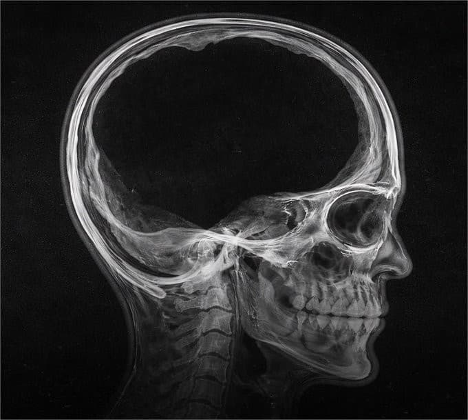 A grayscale lateral radiograph of a human skull and upper neck facing right, with bright skull bones surrounding a large dark cranial cavity and visible facial bones, teeth, eye socket, jaw, and cervical vertebrae.